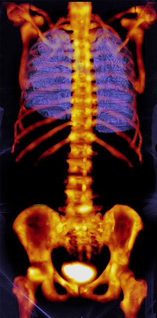 The Symbia Intevo from Siemens Healthcare integrates SPECT and CT enabling a high level of image quality and the ability to differentiate between tissue boundaries in bone imaging.