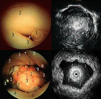 Examples of use of the ultrasound probe in neurosurgery