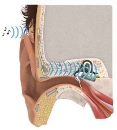 Diagram showing the implanted device