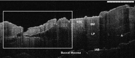 OCT image of oral cancer tissue