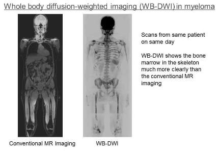 Scan using whole body diffusion-weighted imaging in myeloma compared to conventional MRI