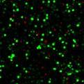 prostate cancer cells after the treatment