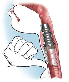 Drawing of the artificial larynx