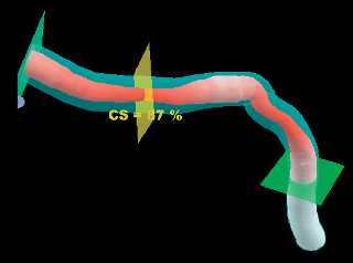 Interventional Cardiac 3D technology provides clinicians with an extremely helpful and important tool in the evaluation of patients prior to stenosis.