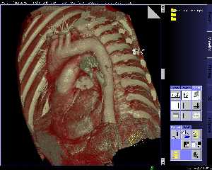 Siemens 64-slice CT scan of heart: developed by Siemens, the Somatom Sensation 64 sets a new benchmark in imaging quality with its ability to visualize the smallest intracranial, pulmonary, mesenteric and peripheral vessels in less than ten seconds.