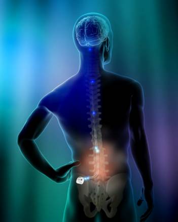 illustration of the eon neurostimulator implanted in a patient